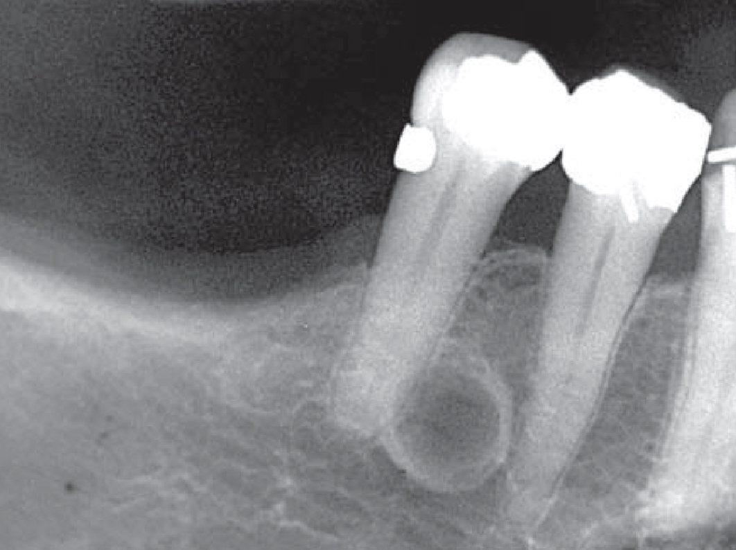 <p>originate from epithelial rests in periodontium</p><ul><li><p>usually unilocular</p></li><li><p>multilocular variant exists → botryoid odontogenic cyst</p></li><li><p>very well-defined and well-corticated</p></li></ul><p></p>