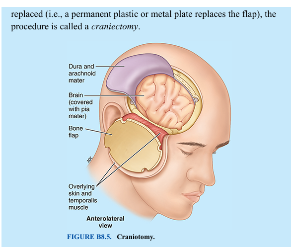<p>Surgeons access the cranial cavity and brain by performing a craniotomy, in which a section of the neurocranium, called a bone flap, is elevated or removed (Fig. B8.5). Because the adult pericranium (periosteum of cranium) has poor osteogenic (bone forming) properties, little regeneration occurs after bone loss (e.g., when pieces of bone are removed during repair of a comminuted cranial fracture). Surgically produced bone flaps are put back into place and wired to other parts of the calvaria or held in place temporarily with metal plates. Reintegration is most successful when the bone is reflected with its overlying muscle and skin so that it retains its own blood supply during the procedure and after repositioning. If the bone flap is not replaced (i.e., a permanent plastic or metal plate replaces the flap), the procedure is called a craniectomy.</p>