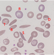 <p>Sickle Cell - Blood Appearance: Boat Cells </p>