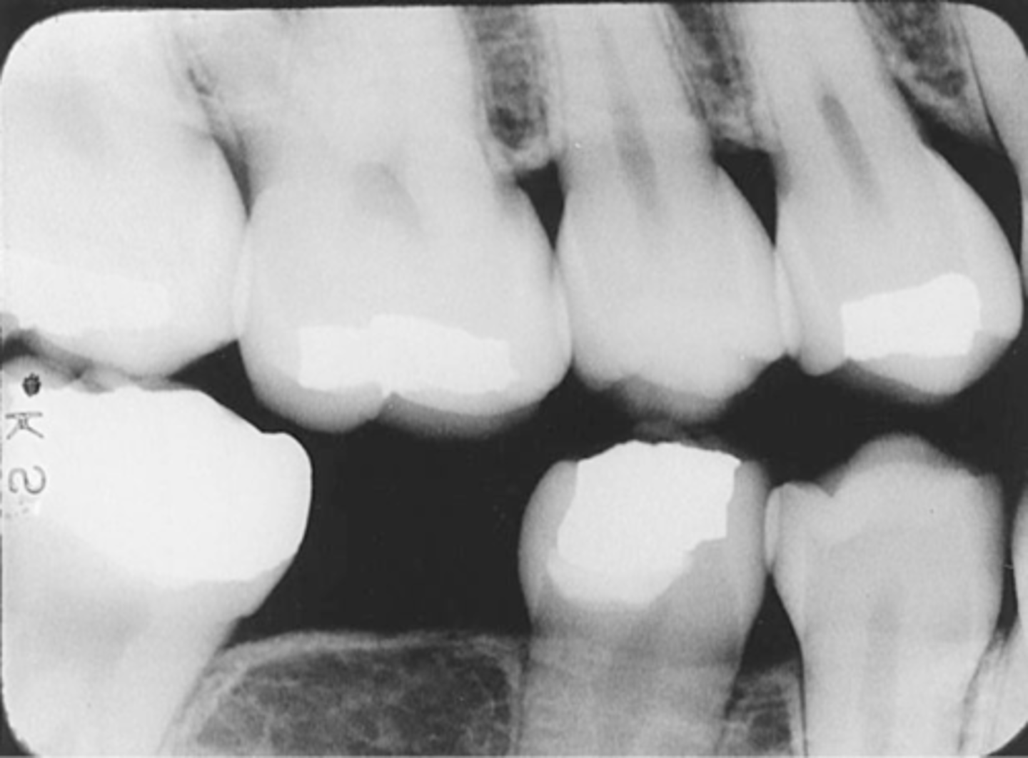 <p>-Overlapped contacts</p><p>-CR was not directed through the interproximal spaces.</p>