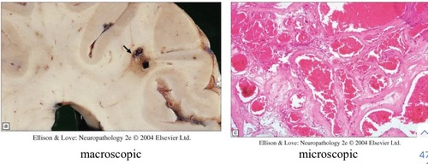 <p>Sinusoidal collections of blood vessels without interspersed brain tissue</p>