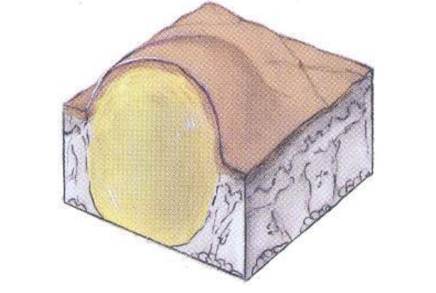 <p>what type of skin lesion is this? </p>