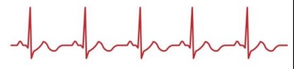 <p>What is a normal trace of an ECG?</p>
