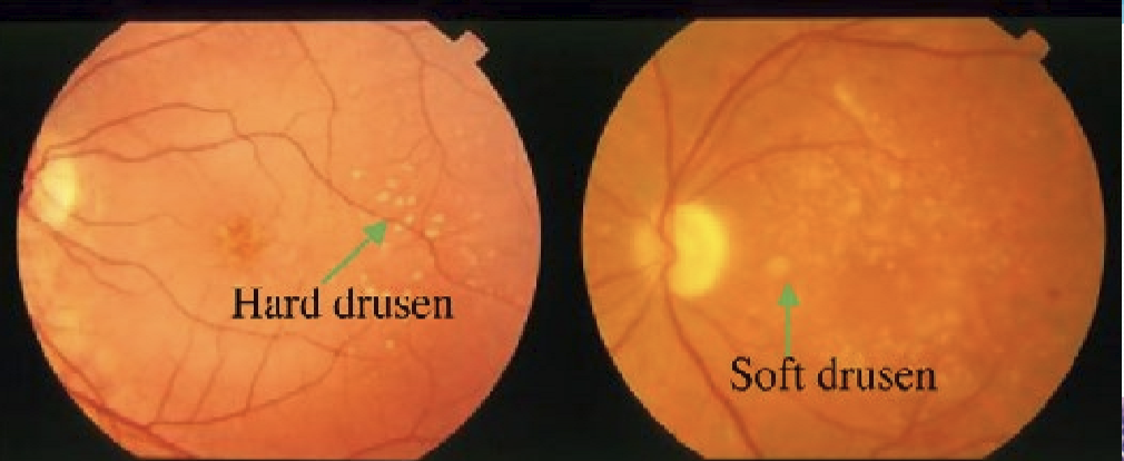 <p>Hard: does not usually affect vision. Soft: increases risk of age-related macular degeneration (AMD) </p>