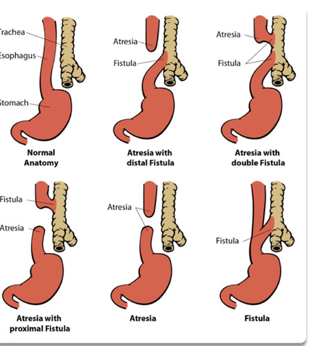 <p>Esophageal atresia</p>
