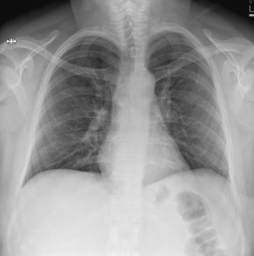 <p>where does the PICC line terminate in this image</p>