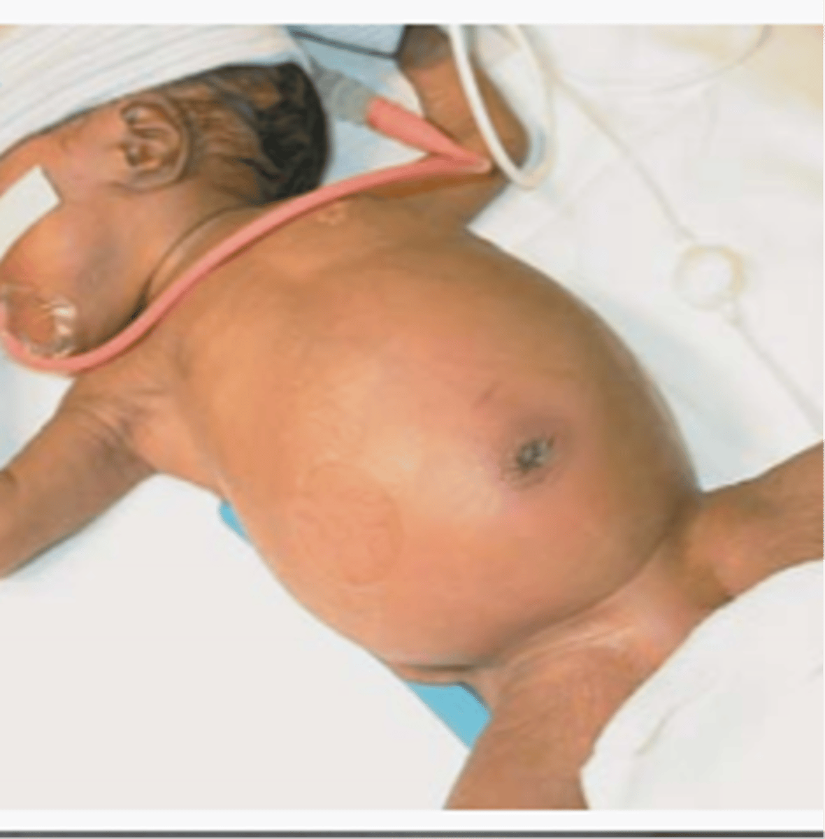 <p>Premature baby who comes in w/ abdominal distension, belly pain, bloody stool, intolerance to feeds, vomiting, diarrhea, abdominal erythema, &amp; possible shock</p>