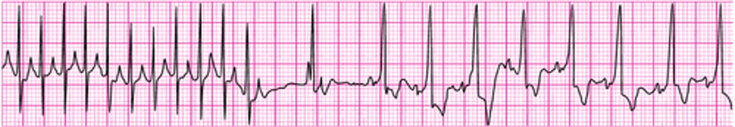 <p>SVT converting to sinus rhythm after adenosine administration</p>