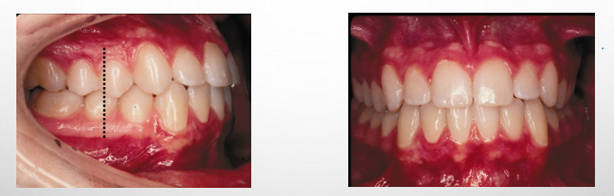 <p>-MB cusp of the maxillary first molar is aligned with the buccal groove of the mandibular first molar</p><p>-there is alignment of the teeth, normal overbite and overjet, and coincident maxillary and mandibular midlines</p>