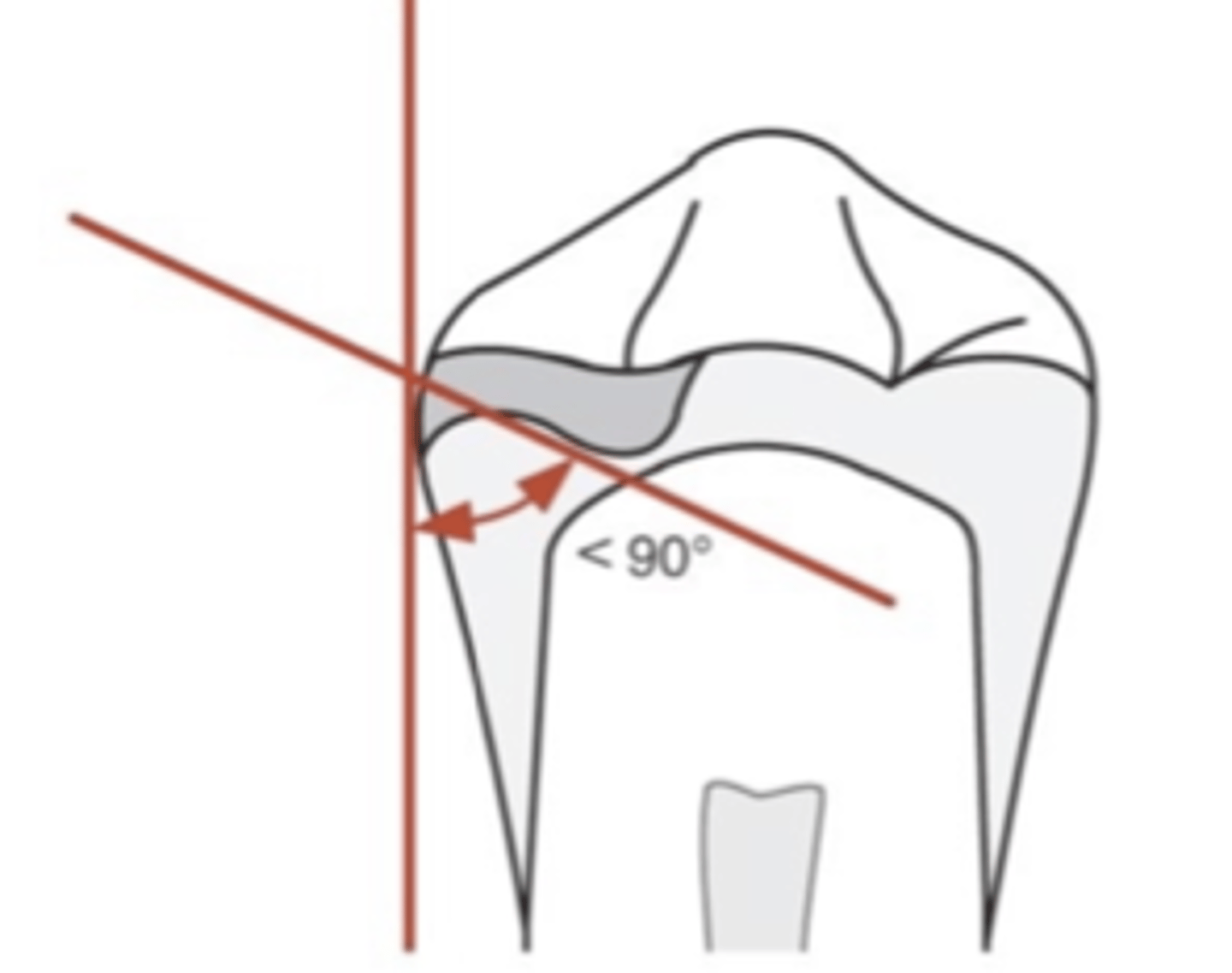 <p>In an occlusal rest, the _______ portion must be located more apically than outer portion near marginal ridge (positivity). May or may not require tooth preparation. If the angle between minor connector and inner portion of rest is ≥90°, occlusal forces will act to slide the rest away from the tooth</p>