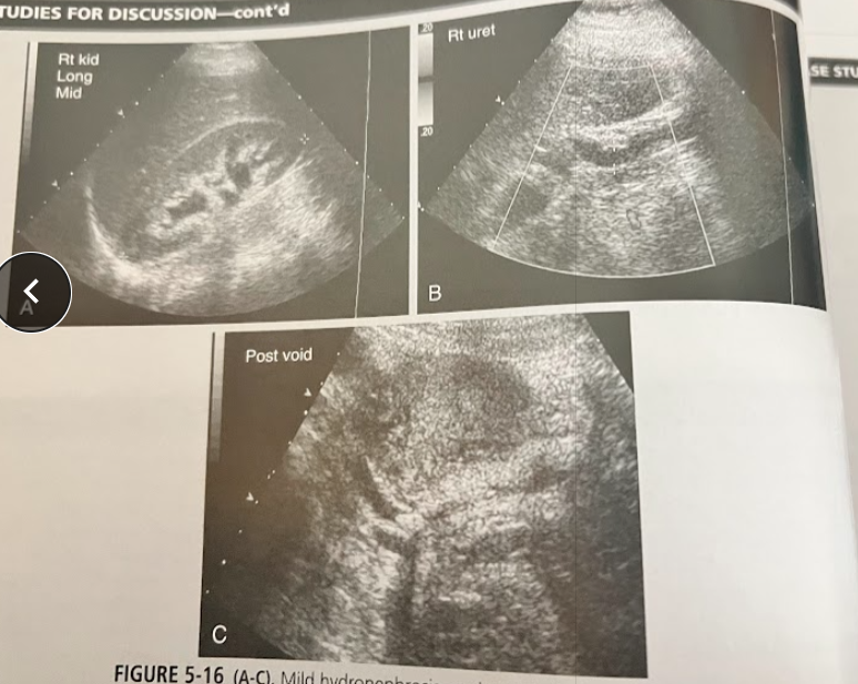 <p>A middle aged woman presents to the ED w/flank pain, N/V and a low grade fever. Urinalysis reveals microscopic hematuria and she is referred for a urinary tract sonogram. The findings are in these images. What is the most likely diagnosis and what scanning techniques should the sonographer employ in completing this exam?</p>