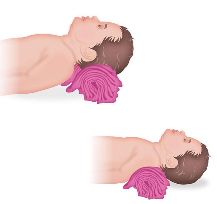 \
__**● Airway patency**__  

○ Kids have a large occiput  

■ Shoulder roll - ‘sniffing position’ 

■ Avoid supine position  

○ Secretions 

■ They can’t get their own boogers out!  

■ Have suction ready  

○ Swelling can occlude airway quickly  

■ Tongue is bigger  

■ Airway is smaller and less rigid  

__**● Breathing**__  

○ “Kids compensate until they fall off a cliff” 

○ Lower lung capacity  

○ Trend their vital signs! If they start to look bad…. Often, they are about to look __***really bad***__ 
