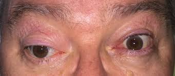 <p><span>eye misalignment caused by weakness or paralysis of one or more extraocular muscles due to nerve damage&nbsp;</span></p>