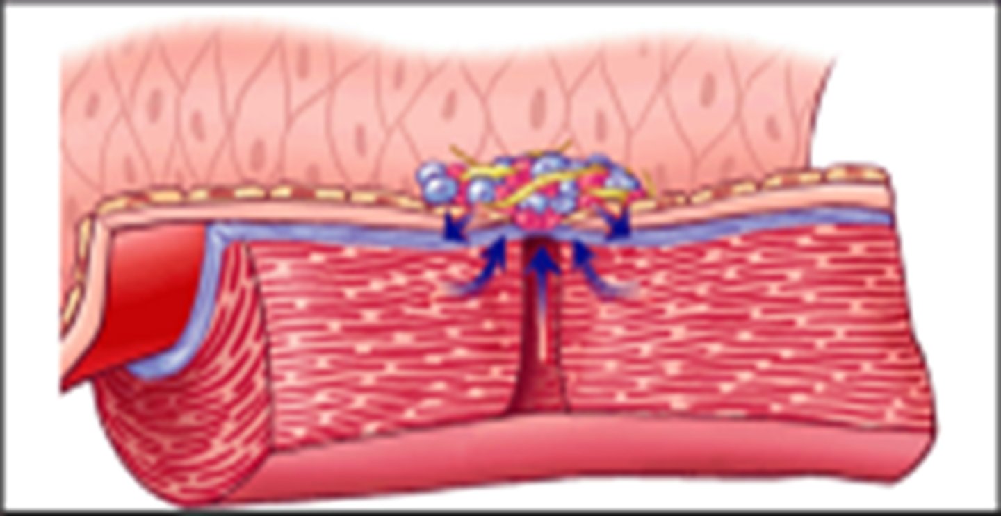 <p>What: The tightening of the fibrin clot</p><p>Why: Fibrin strands between the platelets shrink, pulling the two sides of the fissure closer to each other --&gt; clot tightens</p>