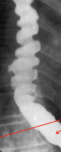 <p>What&nbsp;esophageal disorder is this?</p>