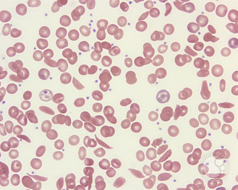 Sickle cell anemia