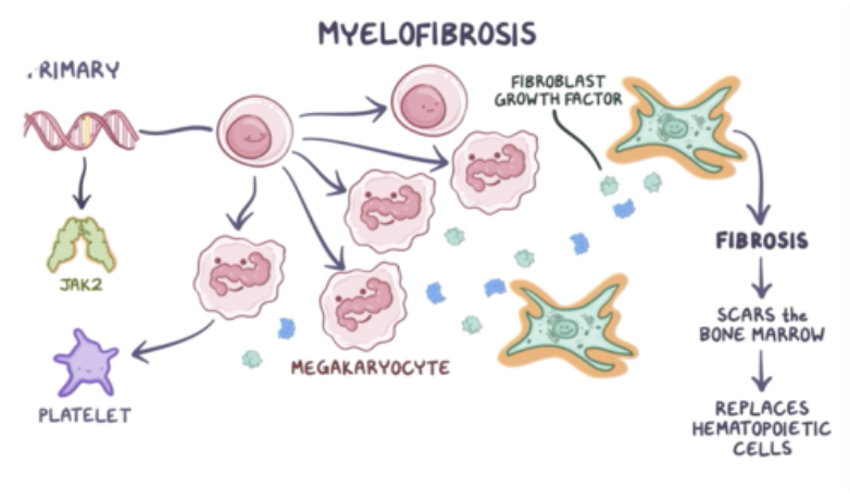 <p>Det är en klonal stamcellssjukdom som påverkar megakaryocyterna → hyperplasi av megakaryocyter leder till ökad produktion av FGF → <strong>benmärgsfibros</strong>. 50% har mutationer i JAK2. I vissa fall får man myelofibros sekundärt till PV eller ET. </p><p>Det leder även till extramedullär hematopoes → <strong>myeloid metaplasi</strong>. </p><p>Det leder initialt till leuko- och trombocytos men utvecklas senare till <strong>penier</strong> av dessa. Man får splenomegali och hepatomegali pga myeloid metaplasi.  Nattliga svettningar kan förekomma. </p>