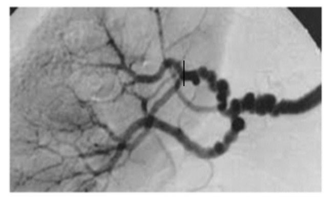<p>____________ develops in the middle to distal end of the renal artery, closer to the kidneys with a string of pearls/beads <span data-name="oyster" data-type="emoji">🦪</span> presentation</p>