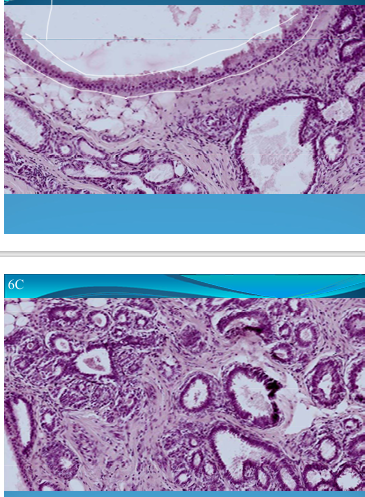 <p>BREAST (Mammary gland):</p><ul><li><p>Fibrocystic mastosis</p></li><li><p>Dilated ducts </p></li><li><p>Glandular and mesenchymal hyperplasia</p></li><li><p>Apocrine metaplasia  = ducts lined by follicular epithelium </p></li><li><p>Inflammatory cells </p></li></ul>