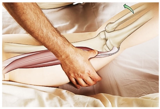 <p>semimembronosus</p>