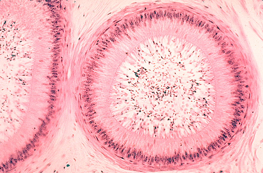 <p class=""><strong>Epididymis</strong></p><p class=""></p><ul><li><p class=""><strong>Long, coiled duct</strong> with a <strong>regular, round lumen</strong></p></li><li><p class=""><strong>Cytoplasm has no nuclei in it (unlike seminif. tubules)</strong></p></li><li><p class="">Lined by <strong>pseudostratified columnar epithelium</strong> with <strong>stereocilia</strong></p></li><li><p class="">Surrounded by <strong>smooth muscle</strong></p></li><li><p class=""><strong>Sperm</strong> often visible in the lumen</p></li></ul><p class=""></p><p></p>