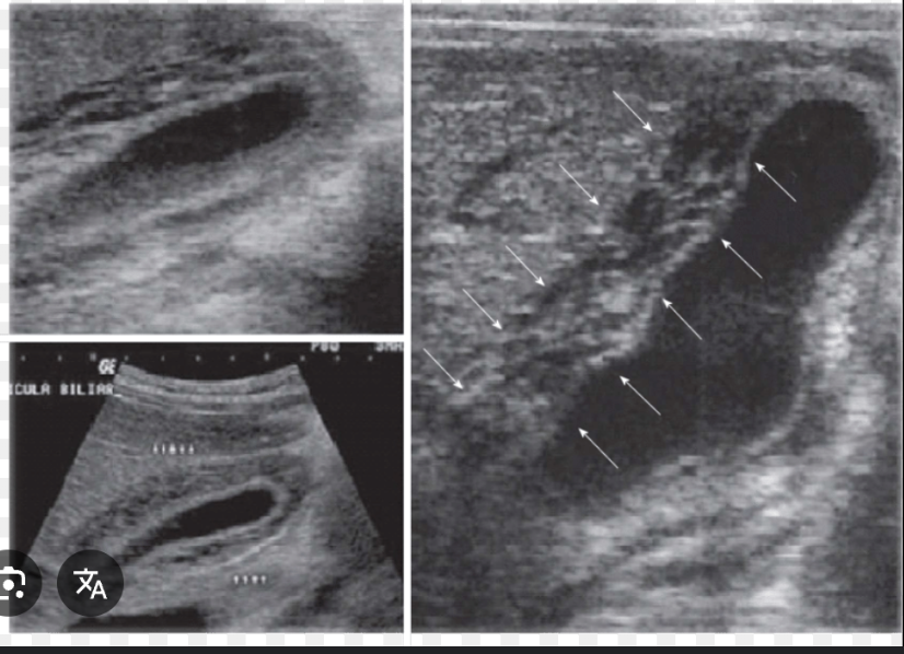 <p>Sonography is used to detect gallstones and evaluate the gallbladder, biliary system, and adjacent organs. Sonography has nearly replaced cholecystography.</p>