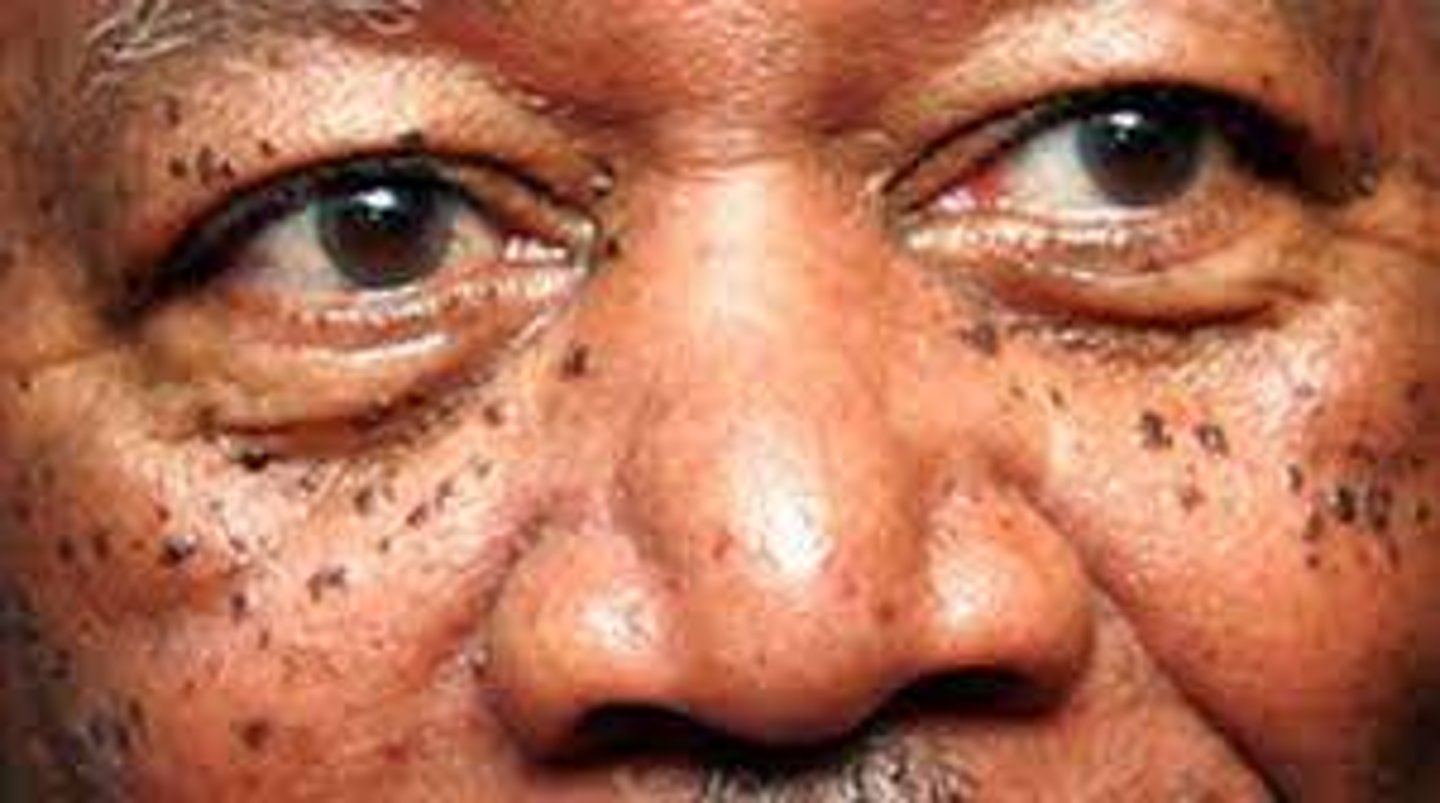 <p>Variant of SK seen in darker skin types</p><p>Multiple small, hyperpigmented, sessile to filiform, smooth-surfaced papules</p><p>Harmless, but can be a cosmetic issue</p>