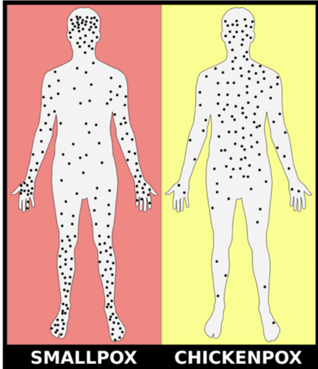 <p>Transmitted via the respiratory route, moves into the bloodstream, and infects the skin</p>