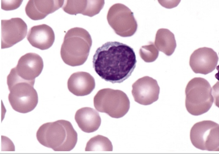 <p>FAB classification that refers to irregular clefts of the nucleus</p>