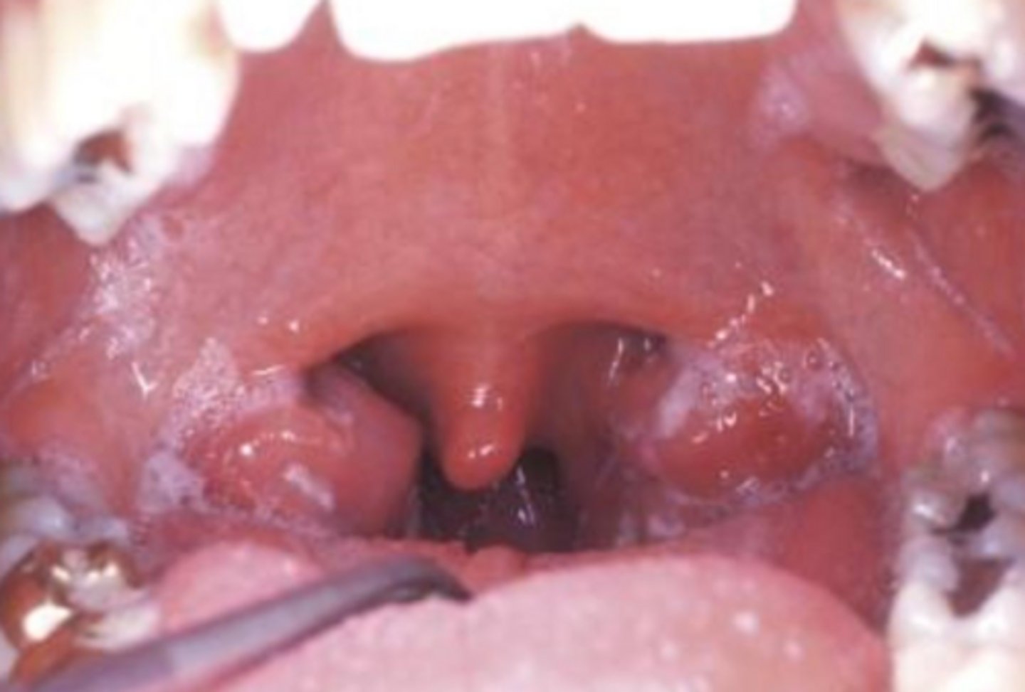 <p>infectious mononucleosis</p>