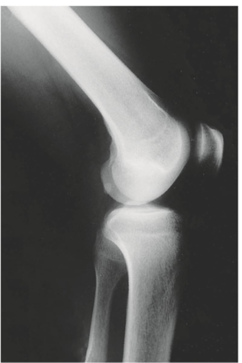 <p>can see patella tracking superiorly/inferiorly<br>- alta = high<br>- baja = low<br>- use for transverse fx patella</p>