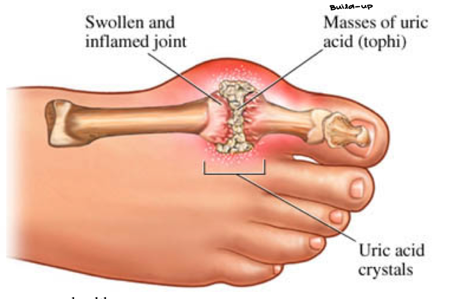 <ul><li><p>What is gout??? Deposition of <strong>needle-like crystals of uric acid into joints</strong>! Diet matters, genetics matter and under-excretion of <strong><em><u>uric acid by the kidney</u></em></strong> are ALL factors!</p><ul><li><p>nitrogenous waste, mostly from the metabolism of the broken down aa… if we cannot get rid of all of them w/ the kidney, these nitrogenous waste we need to get rid of, we need to excrete them</p></li><li><p>these nitrogenous wastes, usually from the bio-metabolism of aa, if we cannot get rid of all of them they will crystallize</p></li><li><p>gravity takes over & these uric acid crystals make their way into our lower extremities</p></li><li><p>uric acid crystals start to accumulate in our feet</p></li><li><p>diet matters, genetics matter</p></li></ul></li><li><p>NOT turf toe!</p></li></ul><p></p>