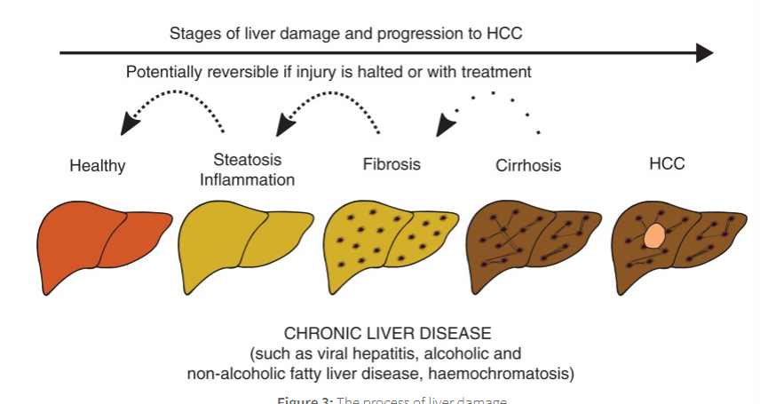<p>where the liver becomes hardened and does not function properly</p>