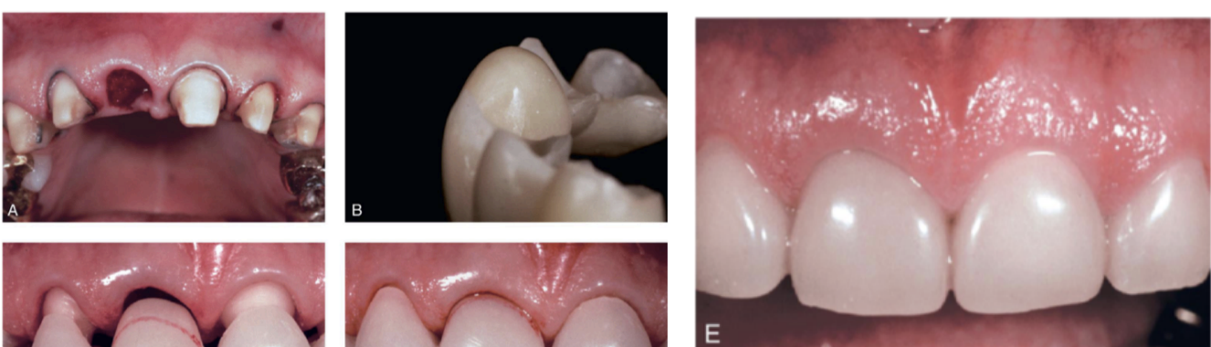 <ul><li><p>immediate restoration and periodontal intervention at the time of tooth removal</p></li><li><p>preparing the abutment before ext</p></li><li><p>fabricate an interim FPD indirectly, ready for immediate insertion</p></li></ul><p></p>