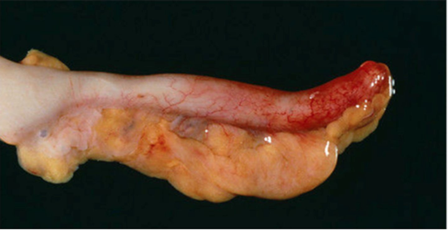 <p>Sudden infectious inflammation of the vermiform appendix often due to obstruction of the appendiceal lumen by a fecalith; lymphoid hyperplasia</p>