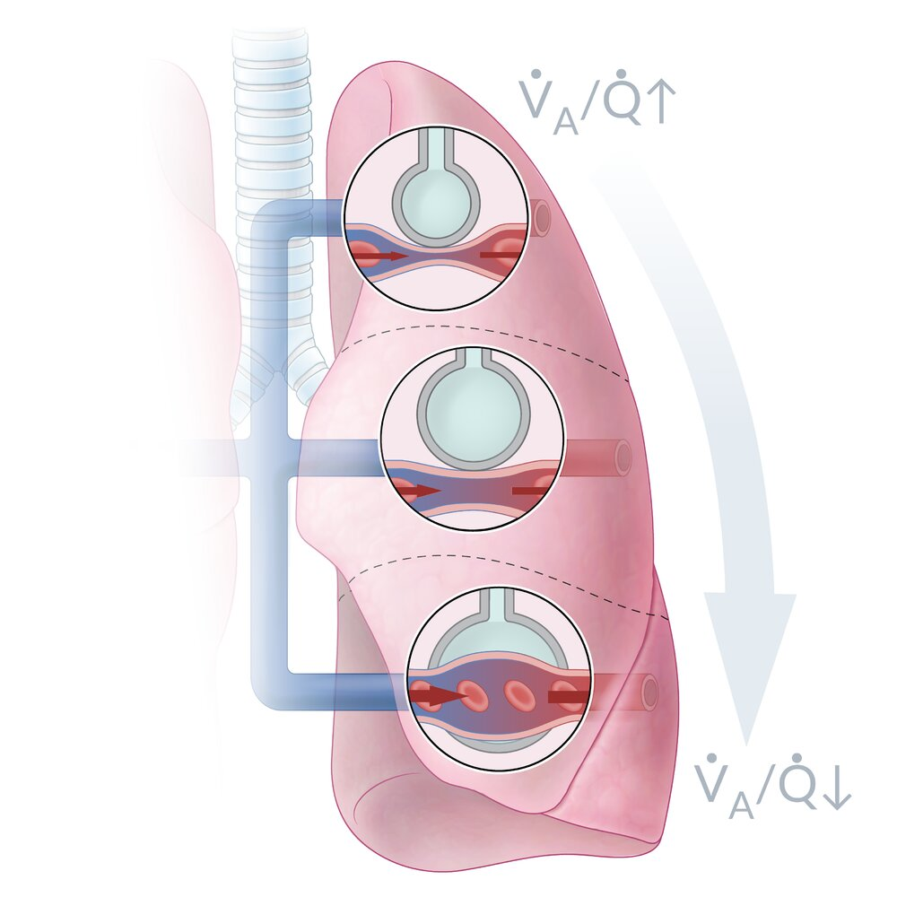 <p>D. Greatest ventilation-to-perfusion ratio at the lung apex</p>