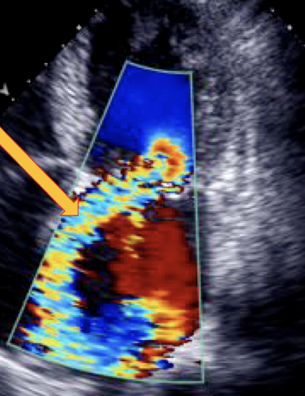 <p><span>•The portion of the jet that is seen in the "receiving camber" (the left atrium) is the "________".</span></p><p><span>•Its size also corresponds to the severity of mitral regurgitation.</span></p>