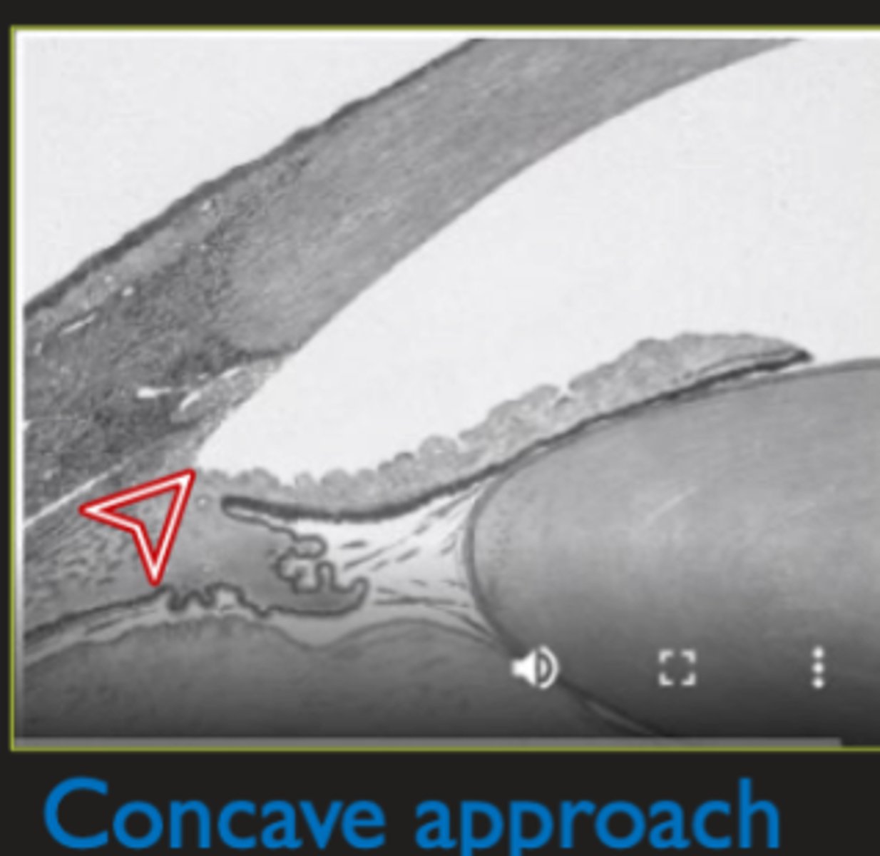 <p>iris bends/concaves backward → can scrape across zones releasing pigment</p>