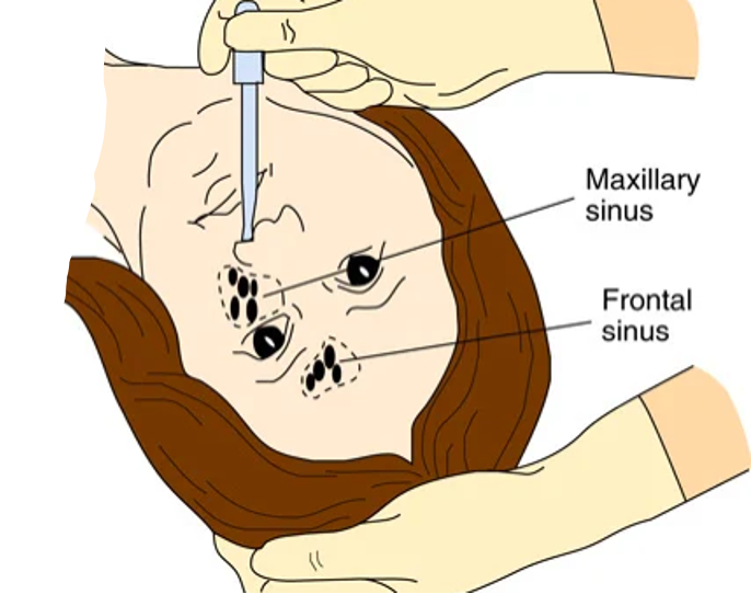 <p>Sprays, drops, tampons (gauze to stop bleeding).</p><p>Decongestant is the most common type.</p><p>Can cause irritation to the nares.</p>