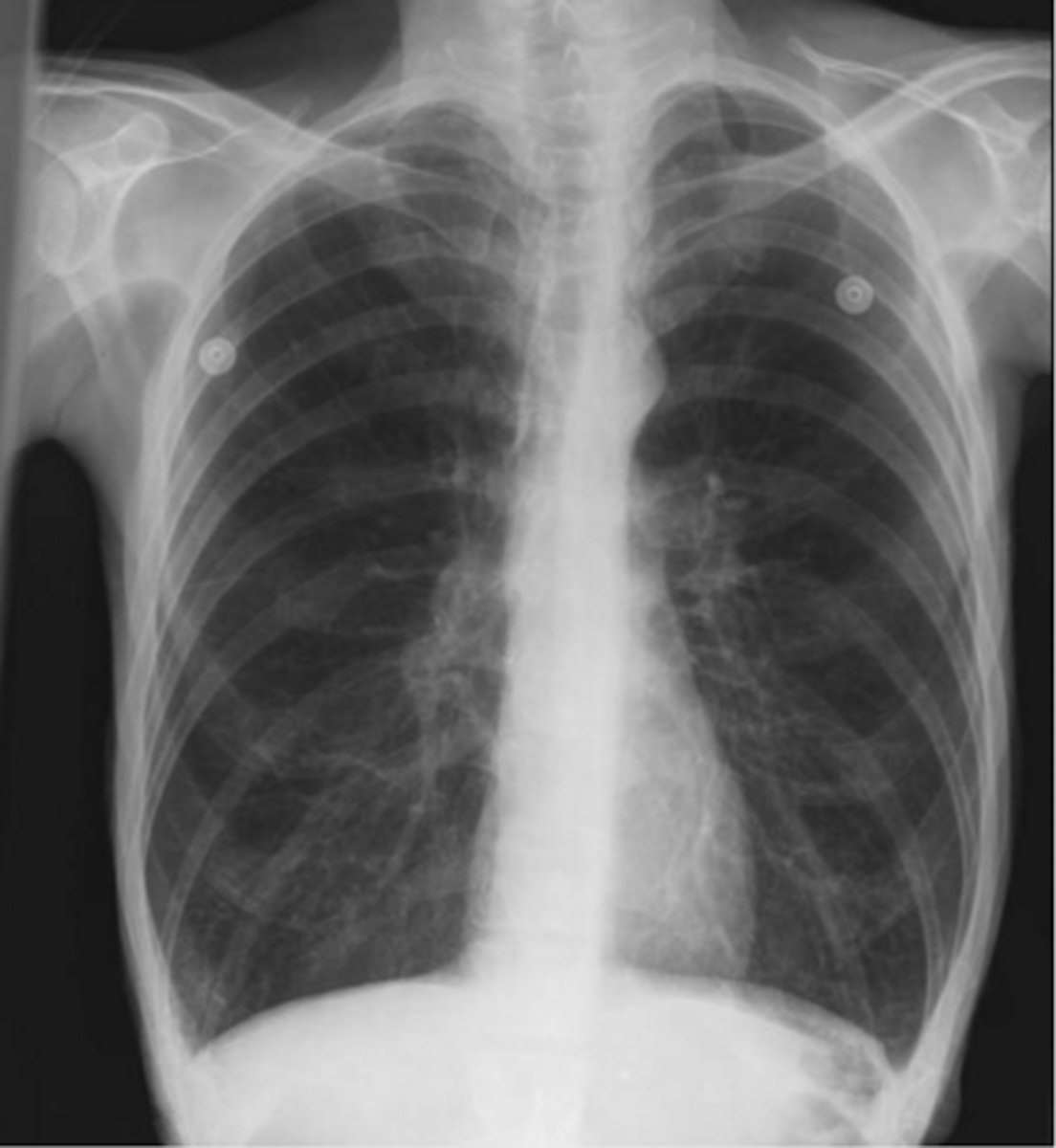 <p>What is this pattern of lung disease? What are the 3 most common diseases this is associated with?</p>