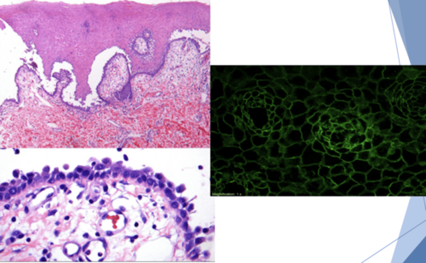 <p>What condition has this histology?</p><p>- Perilesional tissue required for diagnosis</p><p>- I<strong>ntraepithelial separation above basal layer </strong>(SUPRA-basilar cleavage)</p><p><u>- Acantholysis of spinous layer</u></p><p><strong>- Rounded Tzanck cells</strong></p><p>- Generally <u>positive</u> w/ direct/indirect immunofluorescence</p>