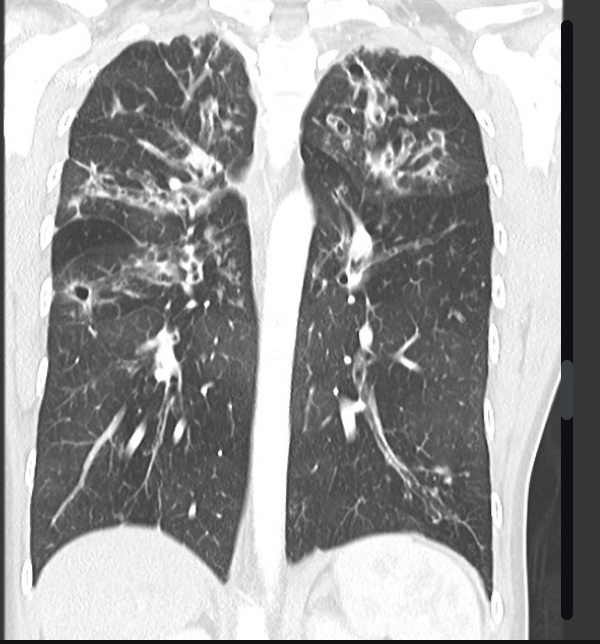 <p>What’s a chest CT going to show cystic fibrosis?</p>