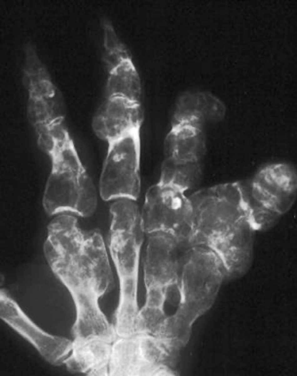 <p>- Multiple enchondromas</p><p>- Malignant transformation (10-50%)</p>