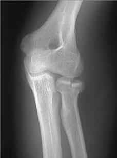 <p>Describe the fracture </p>