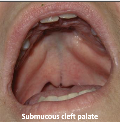 <p><span style="color: #000000">Surface is intact, but defect exists in the underlying musculature of the soft palate</span></p>