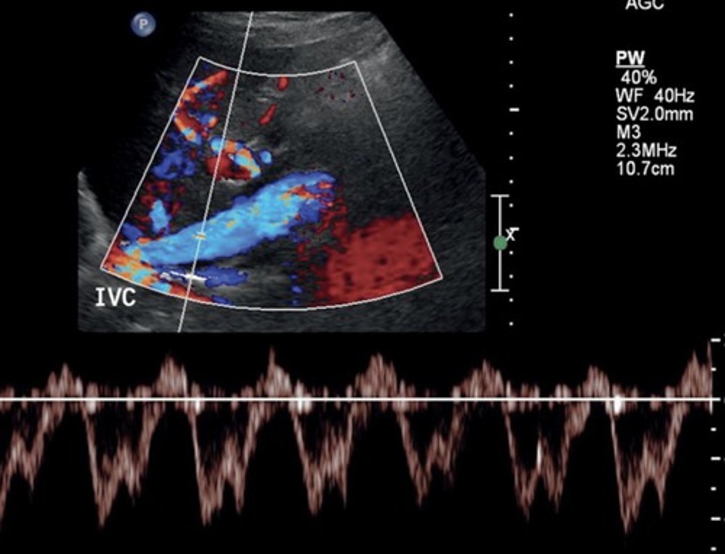 <p>44-118 cm/sec</p><p>Increases with inspiration</p>