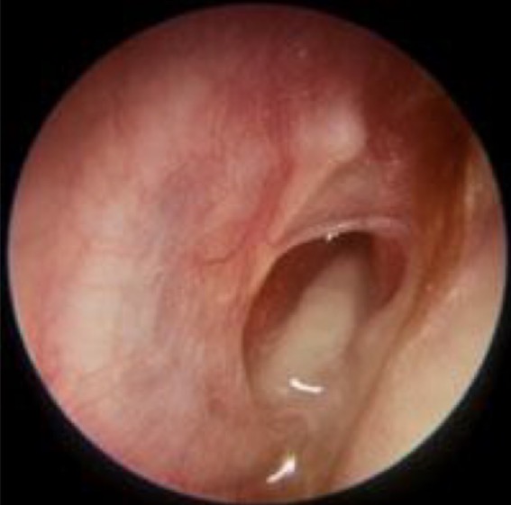 <p>Comment on this tympanic membrane</p>