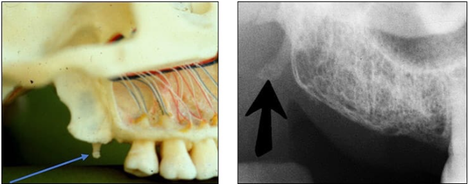<p>Hamulus (Hamular process) </p><ul><li><p>small hook-like projection of bone extending from the medial pterygoid plate of the sphenoid bone</p></li><li><p><u>Radiography: </u><strong><u>radiopaque</u></strong><u> hook-like projection posterior to the maxillary tuberosity area </u></p></li></ul><p></p>