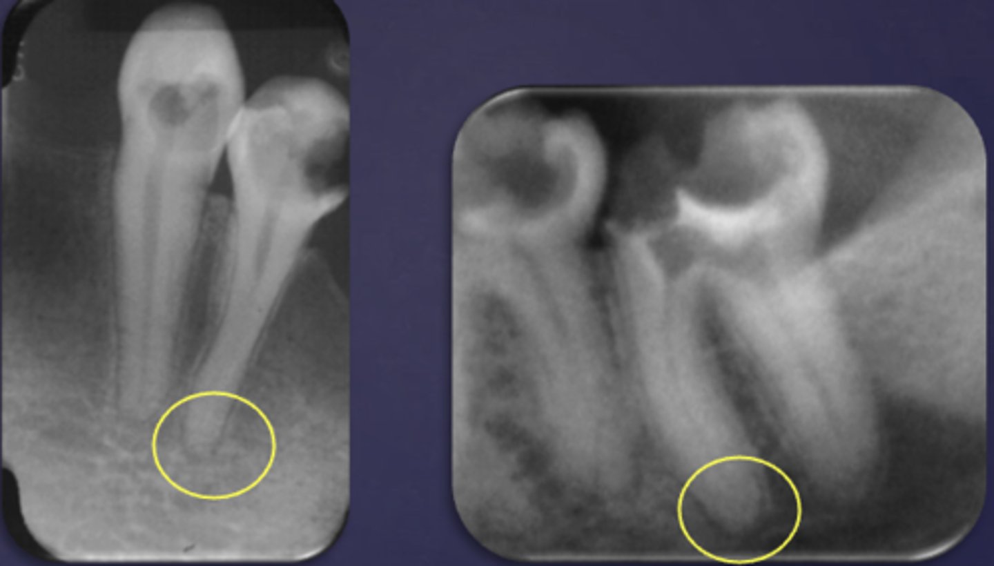 <p>What are two radiographic signs of apical periodontitis?</p>