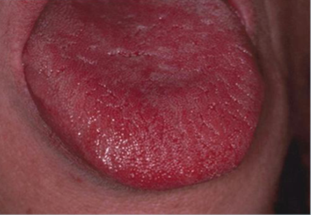 <p>occurs after antibiotics </p>